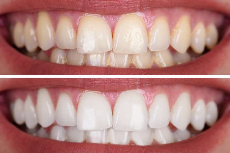 clareamento dental - benefícios