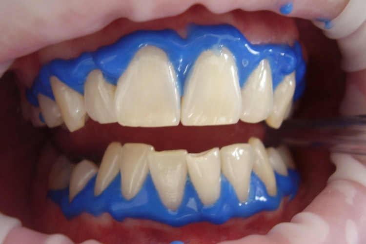 clareamento dental no consultório