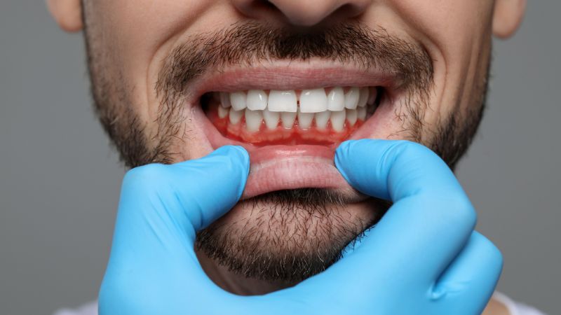 Paciente com gengivite recebendo tratamento no dentista.